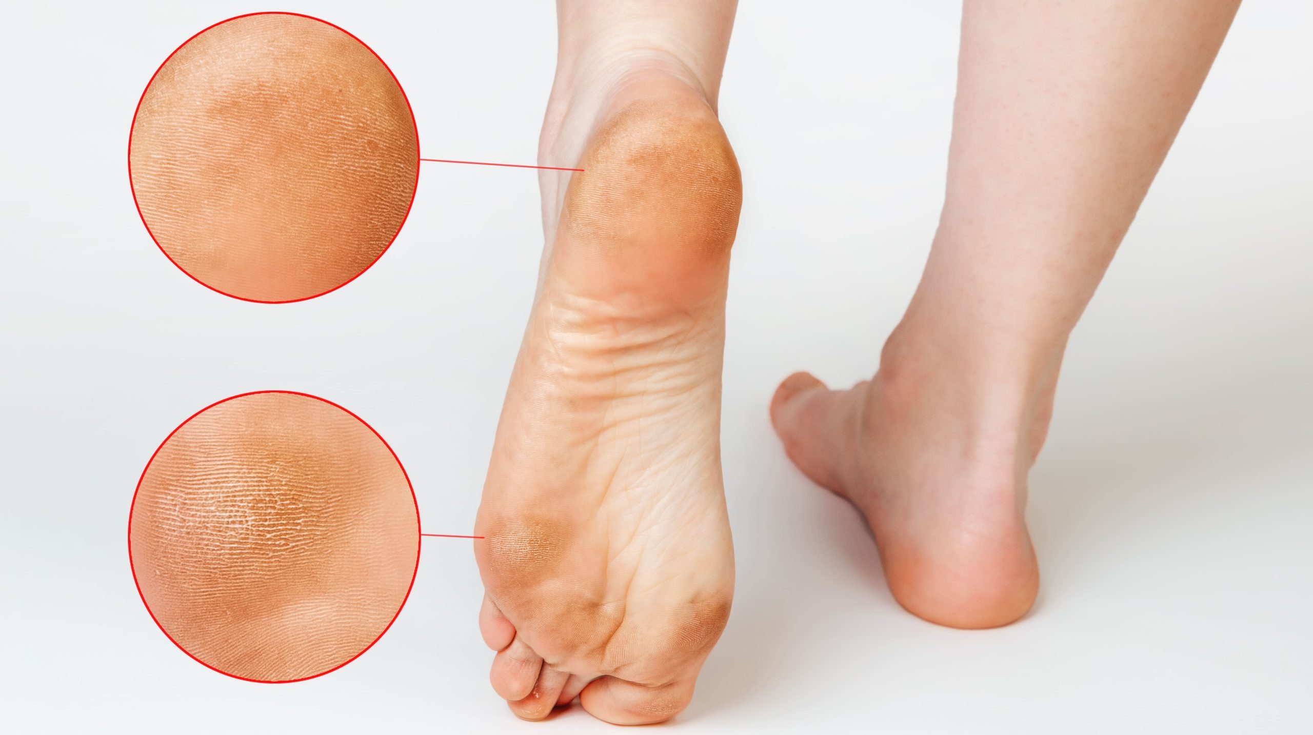 es importante aprender cómo quitar los callos en los pies